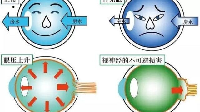 持续眼压监测